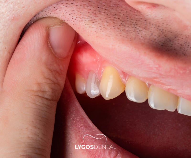 Wat is een tandcyste?