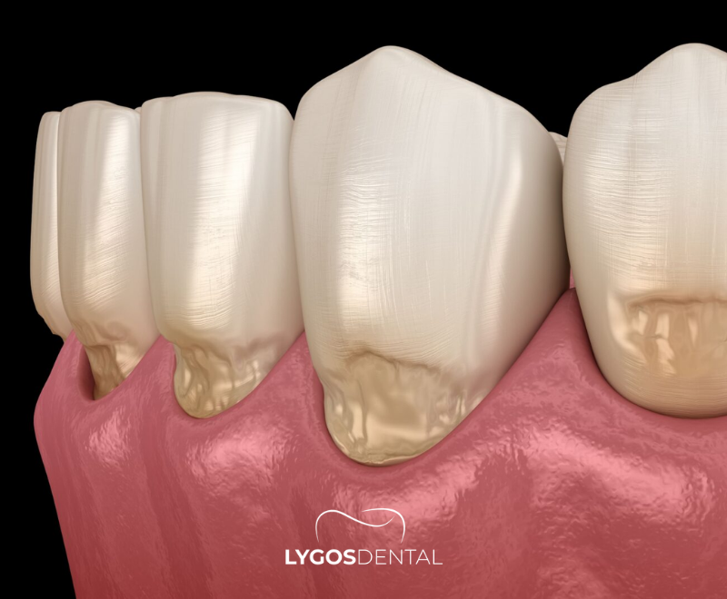 What Is a Tooth Lesion?