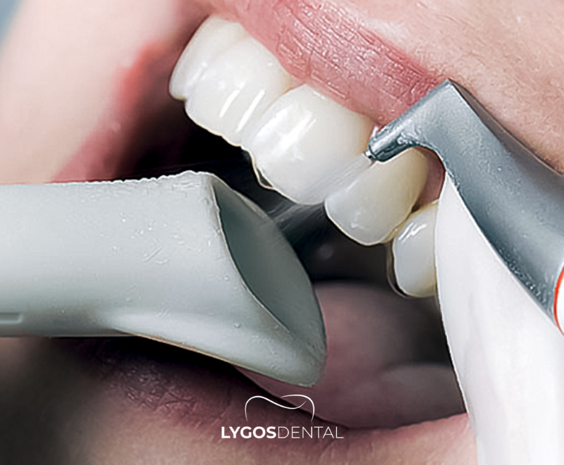 Painless Teeth Cleaning with Airflow 1 What is Airflow?