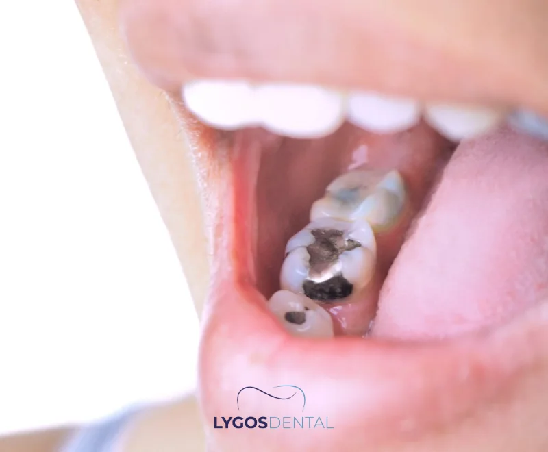 What is Amalgam Filling? 22 What is Amalgam Filling?