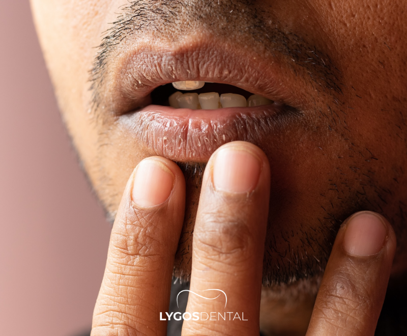 What Causes Dry Mouth? 1 What is Dry Mouth?