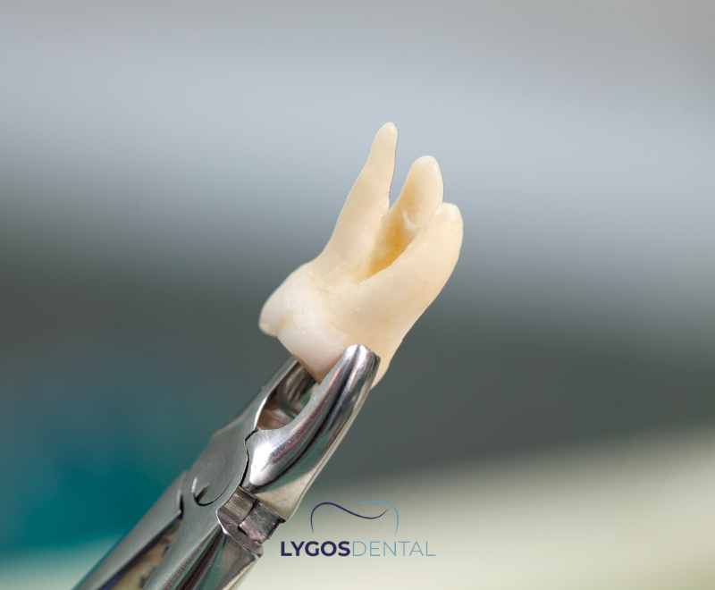 What is Surgical Tooth Extraction 19 What is Surgical Tooth Extraction?