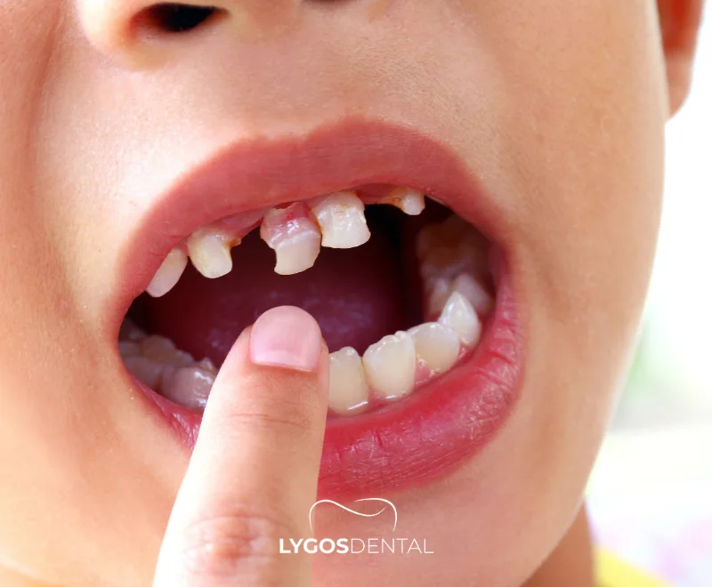 Why Is Dental Care Important for Children?