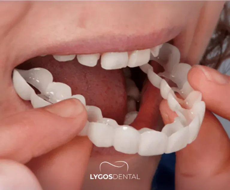 Upper Dental Implants Cost 2 Hidden Costs of Upper Dental Implants