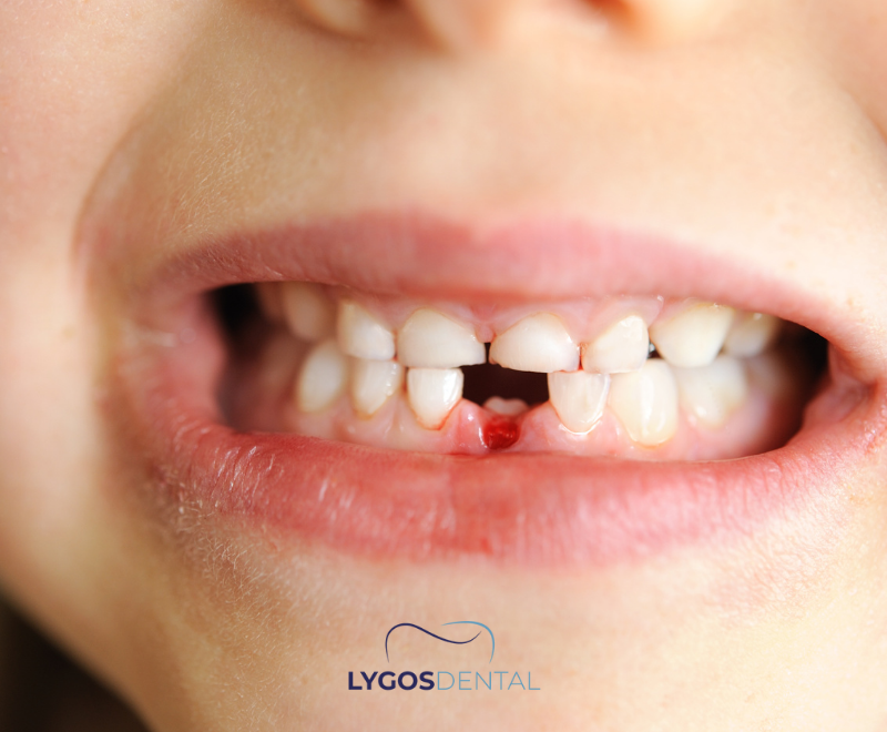 Common Dental Emergencies in Children