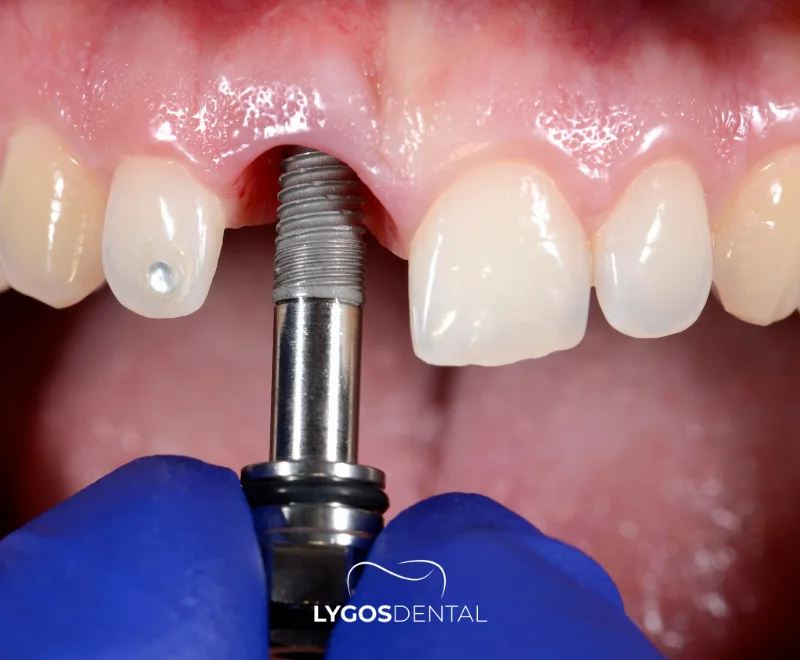 What is Anodontia 18 Treatment Methods for Anodontia