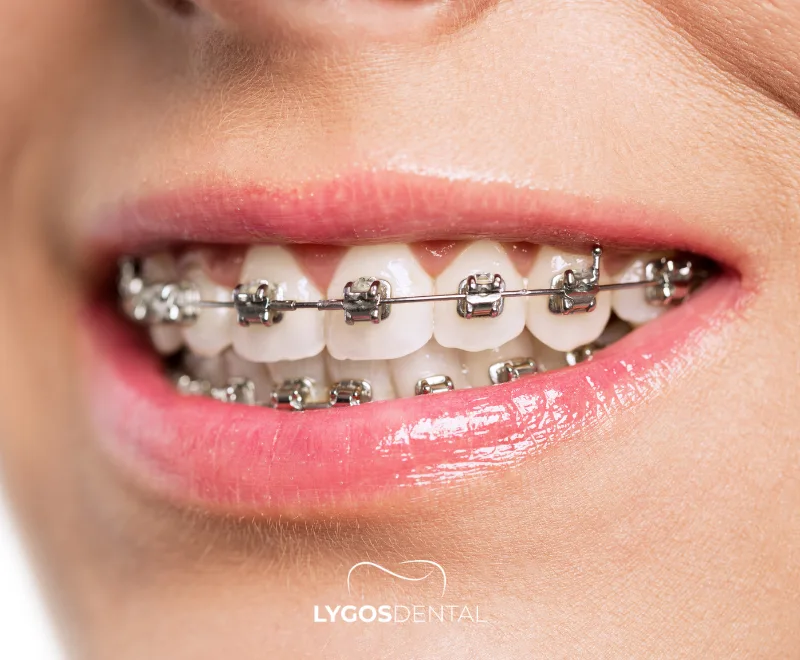 O Que São Aparelhos Ortodônticos? Tipos, Benefícios, Tempo De Tratamento E Custos 1 O que é um aparelho ortodôntico?