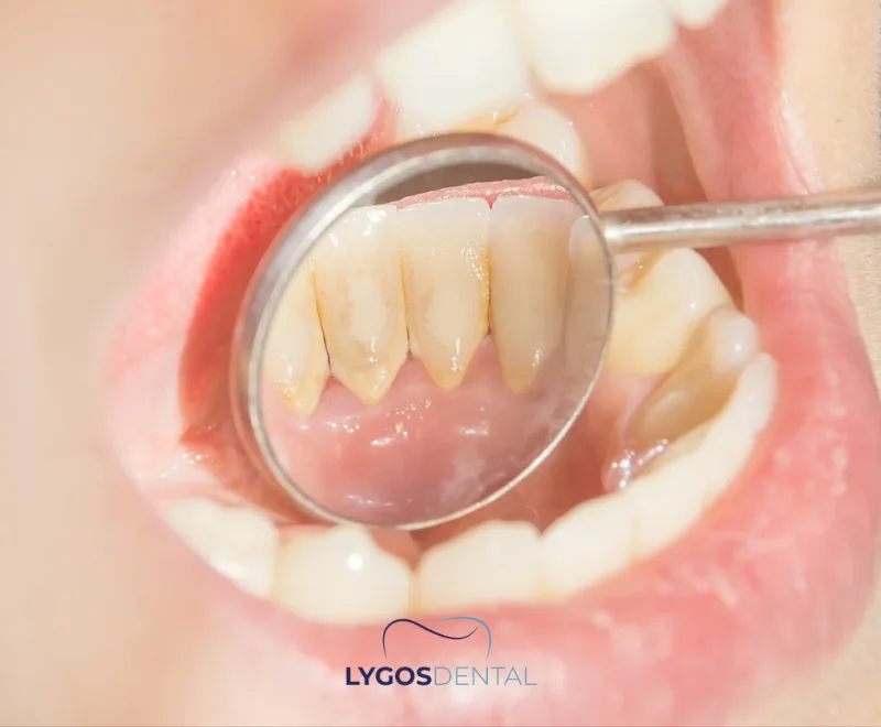 What Causes Gum Pain?