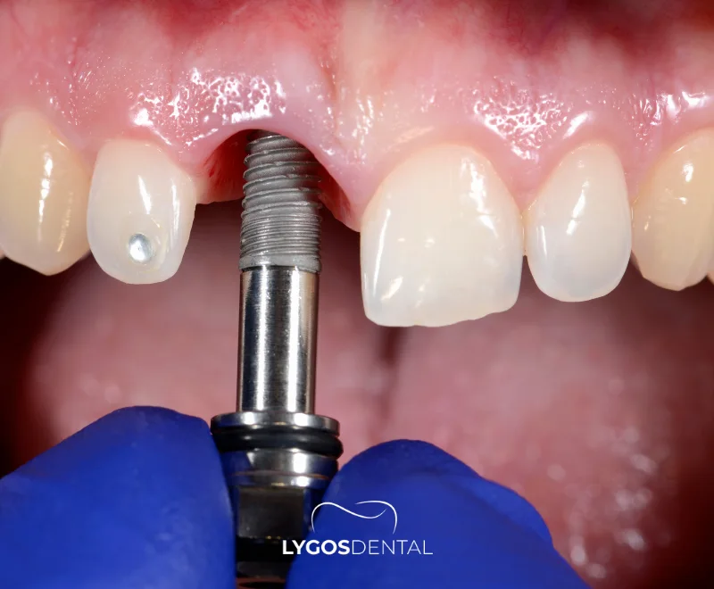 Upper Dental Implants Cost 1 What is an Upper Dental Implant?
