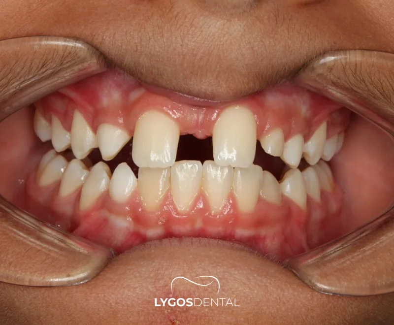 What is Anodontia 16 What is Anodontia?