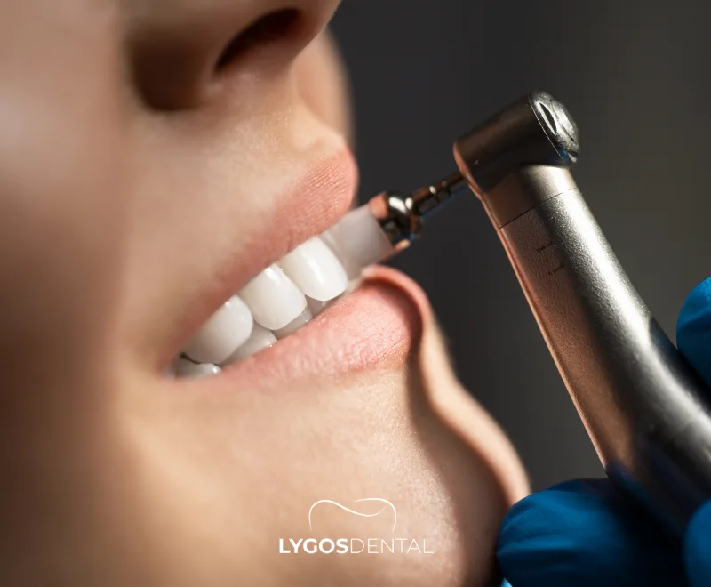 Dental Cleaning Cost Without Insurance 4 What is Dental Cleaning?