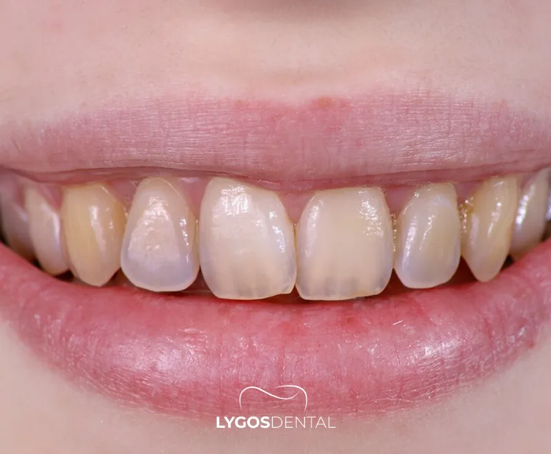 Dentinogenezis İmperfekta Nedir?