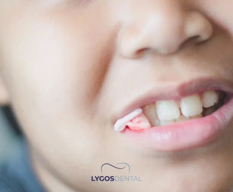 Things To Consider Before And After Tooth Extraction 2 What Should You Do in the First 24 Hours After Extraction?