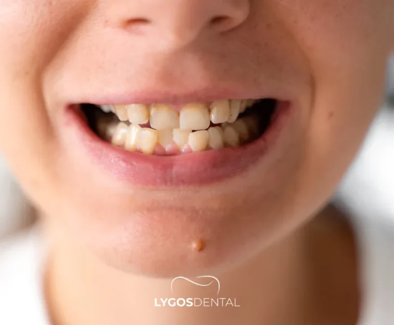 O Que São Aparelhos Ortodônticos? Tipos, Benefícios, Tempo De Tratamento E Custos 2 Para quem são os aparelhos ortodônticos?