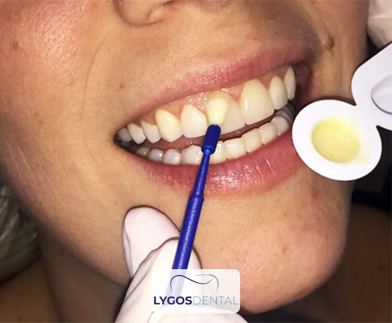 What is Fluoride Treatment and What Does It Do?