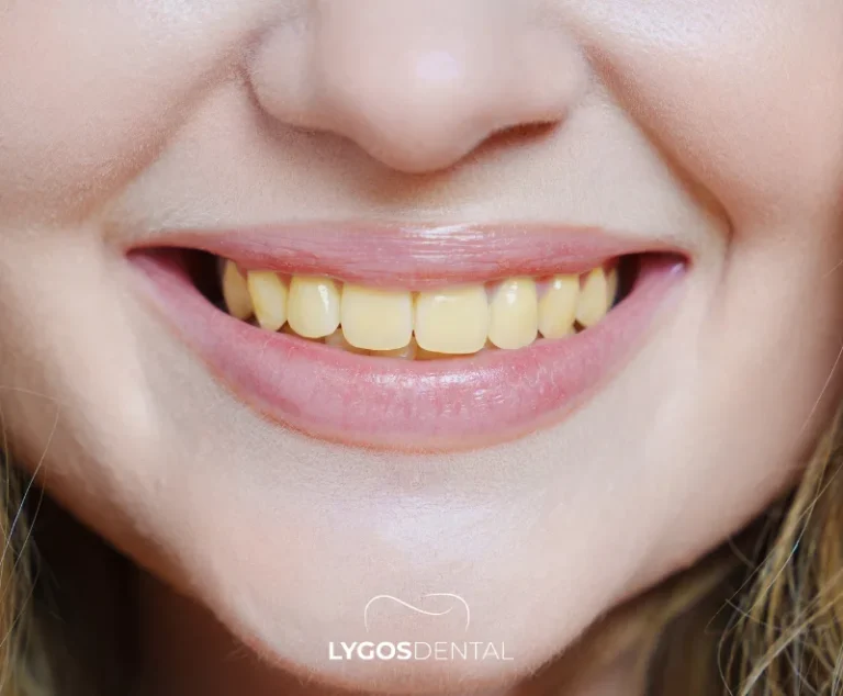 Daño al esmalte dental causado por bebidas carbonatadas