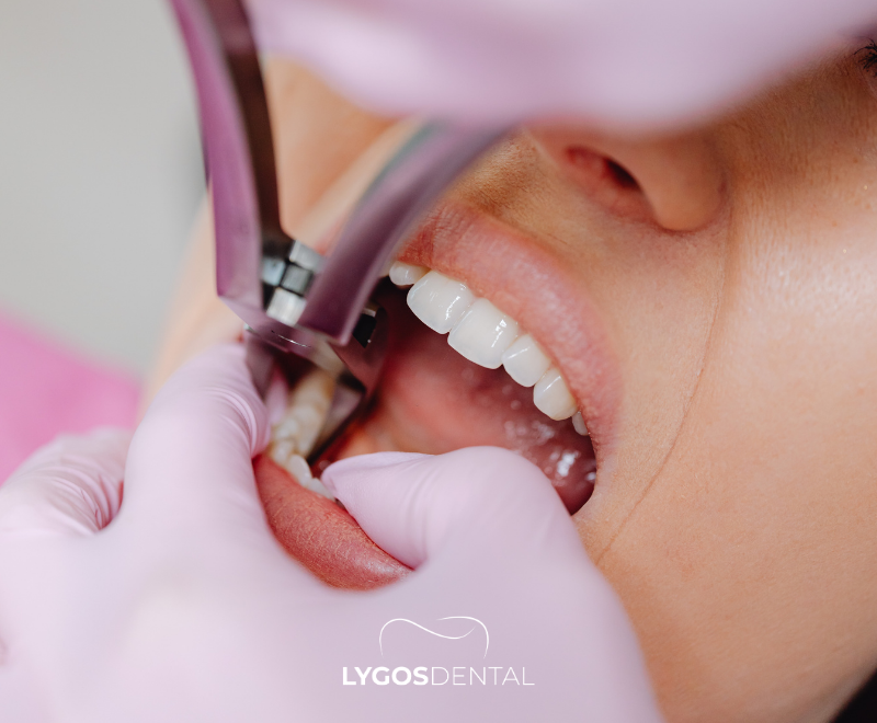 What is Pericoronitis? 3 How is Pericoronitis Treated?