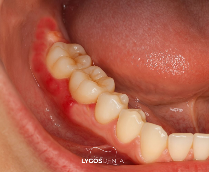 What is Pericoronitis? 1 What is Pericoronitis