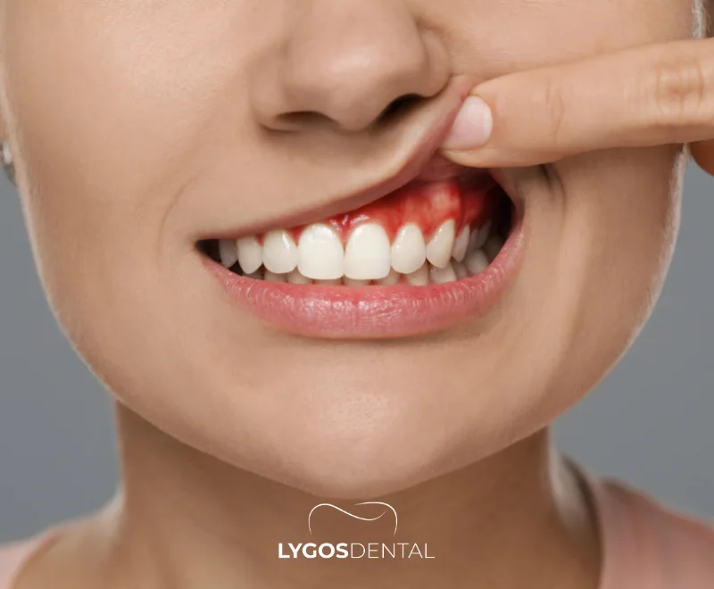 How Do Gum Diseases Affect Heart Health? 1 What Are Gum Diseases?