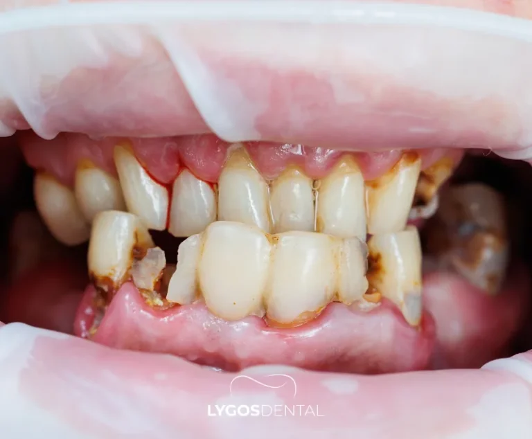 What Causes Gum Swelling?