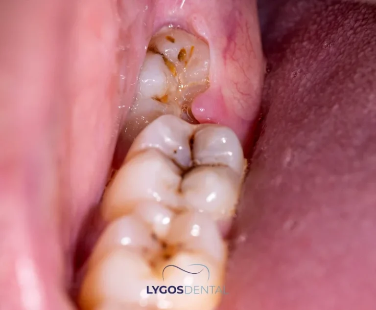 Was passiert, wenn ein verlagerter Zahn nicht entfernt wird?