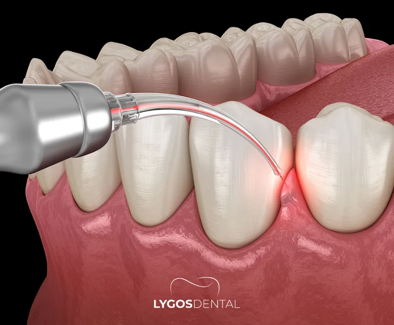 Qu'est-ce que le traitement des gencives au laser ?