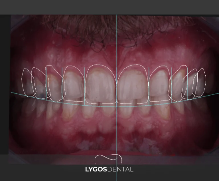 Smile Design Prices 1 Factors That Affect Smile Design Prices