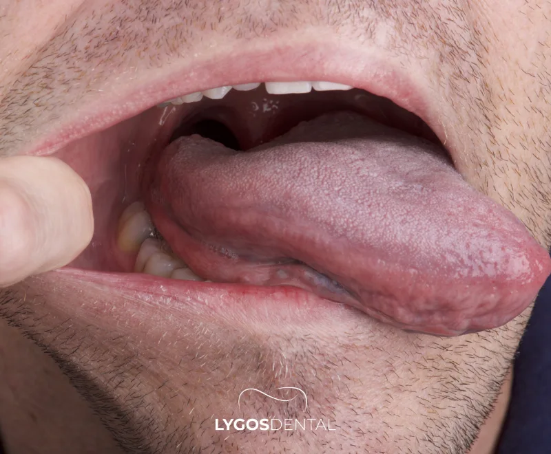 How Does Using a Tongue Cleaner Affect Dental Health? 3 Common Mistakes When Using a Tongue Cleaner