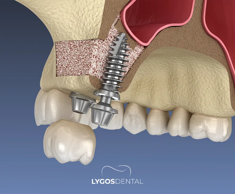 Was ist ein Sinuslift? 1 Was ist ein Sinuslift?