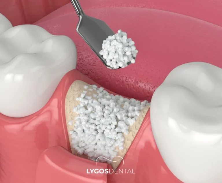 Was ist ein Sinuslift? 2 Wie wird ein Sinuslift durchgeführt?