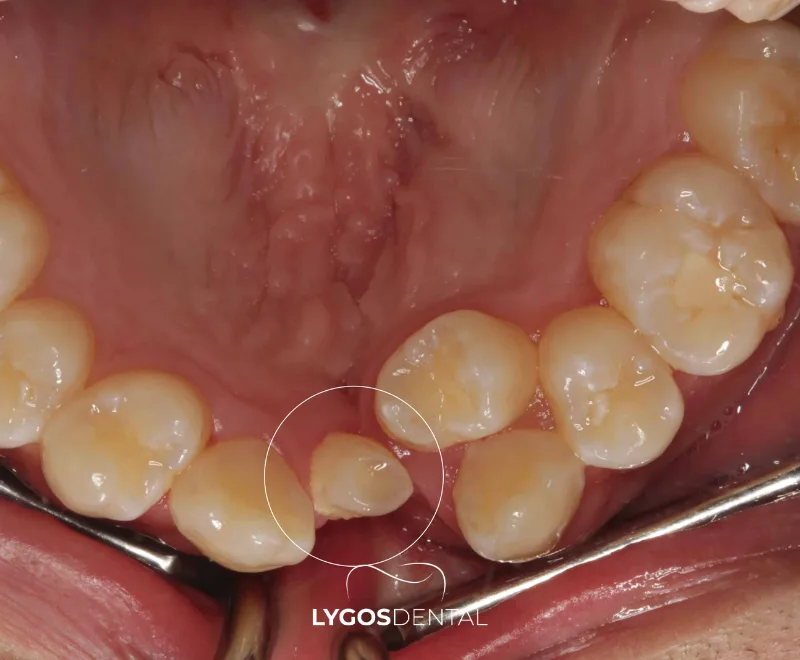 What Is an Ectopic Tooth?