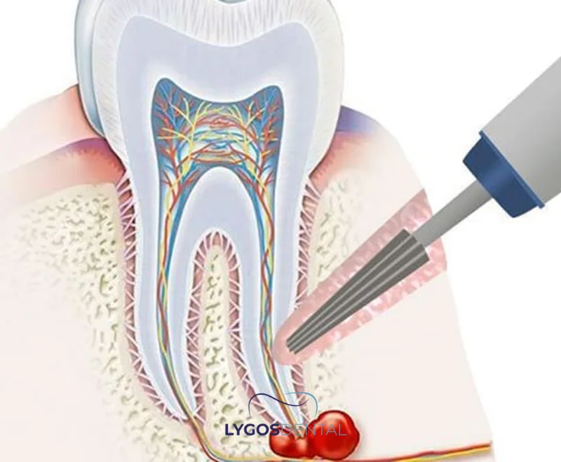 What is Apical Resection?