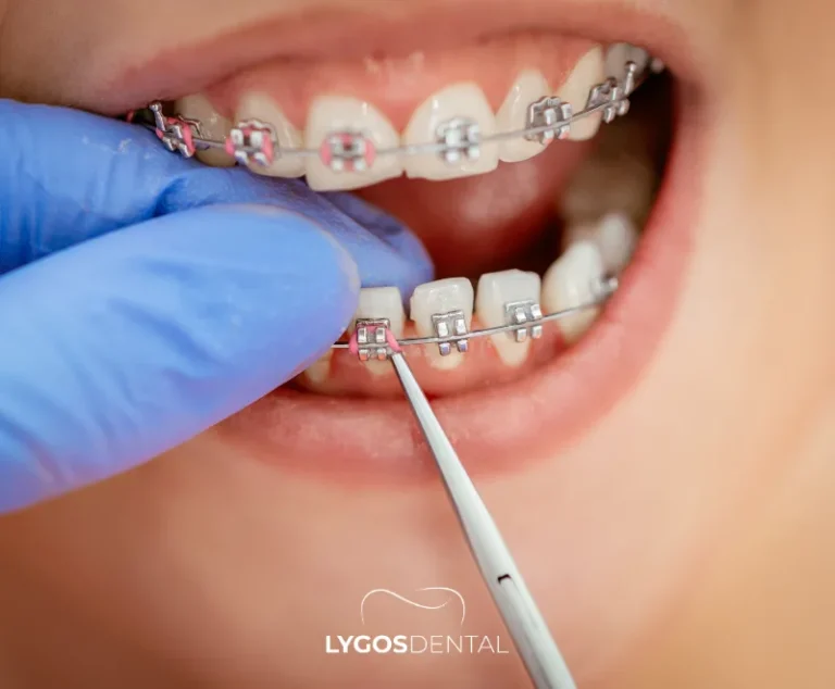 How to Close Gaps Between Teeth?