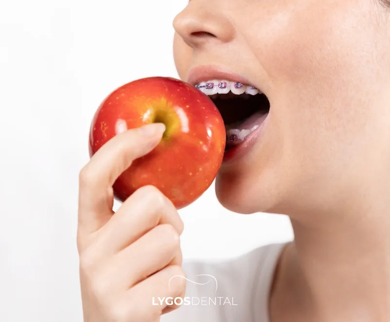 Things You Need to Know Before Getting Braces 3 What to Pay Attention to Before Getting Braces