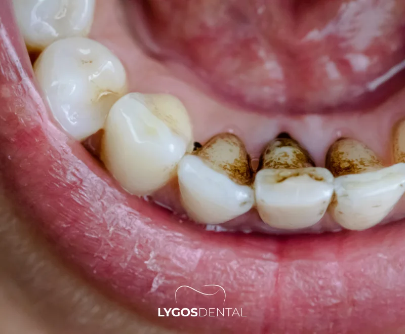 What Is a Tooth Stain?