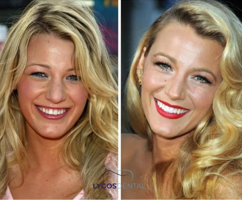 Traitements dentaires esthétiques préférés des célébrités 1 Qu’est-ce qu’un sourire hollywoodien