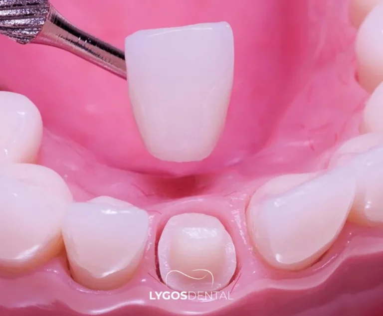 Traitements dentaires esthétiques préférés des célébrités 2 Pourquoi la couronne en zircone est-elle si populaire en esthétique dentaire