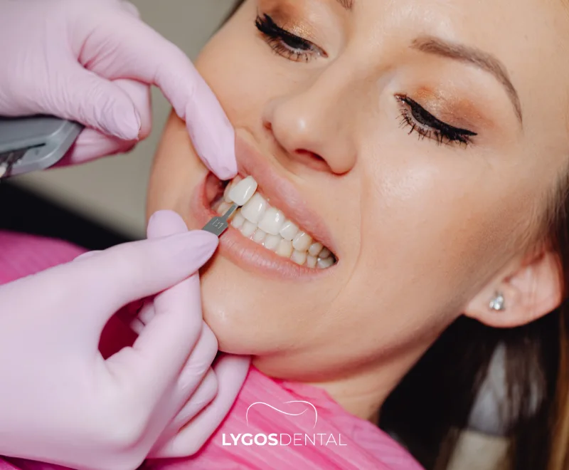 Laminate Veneer Prices 1 What Is a Laminate Veneer?