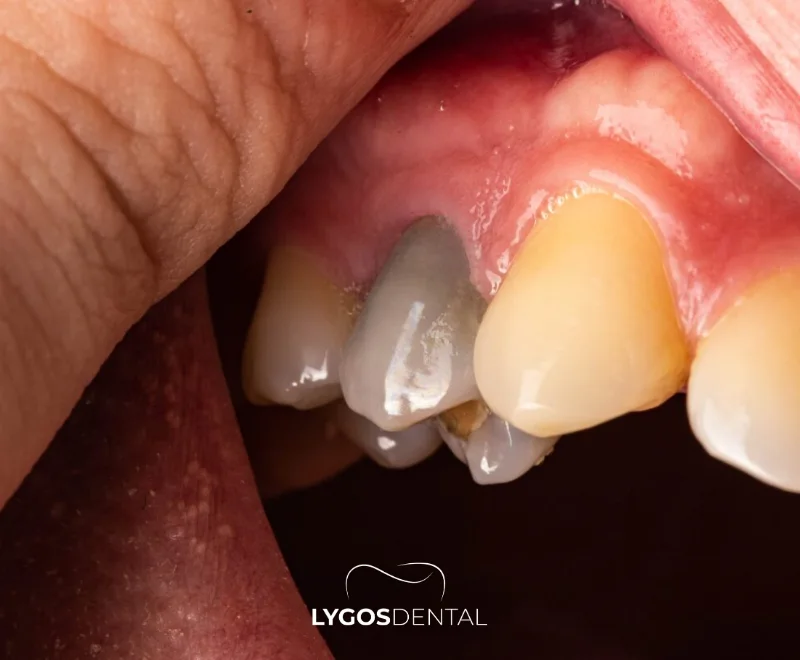 Can Root Canal Treated Teeth Be Whitened? 1 Can Root Canal Treated Teeth Be Whitened?