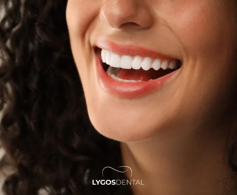 Emax Veneers Durability