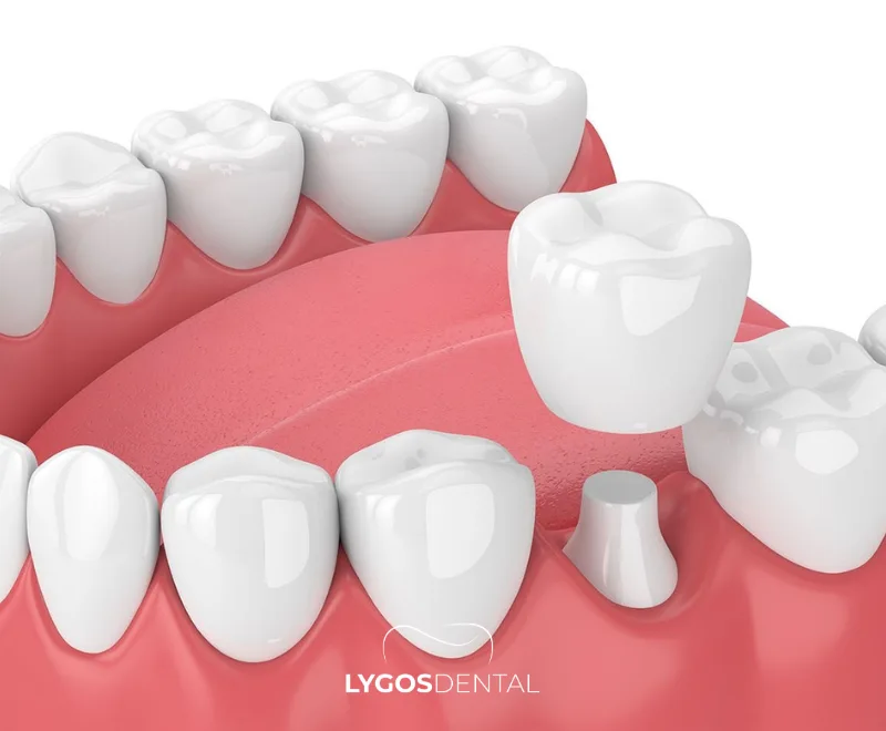 Zirkoniumkrone oder metallgestützte Krone? 1 Zirkoniumkrone oder metallgestützte Krone?