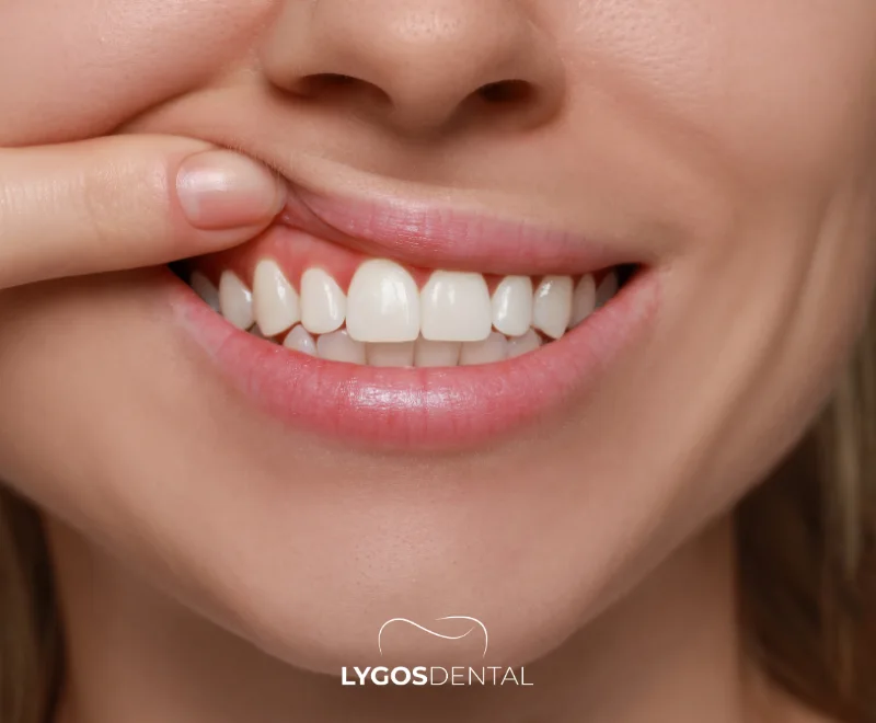 Zirkoniumkrone oder metallgestützte Krone? 3 Zirkoniumkrone oder metallgestützte Krone?