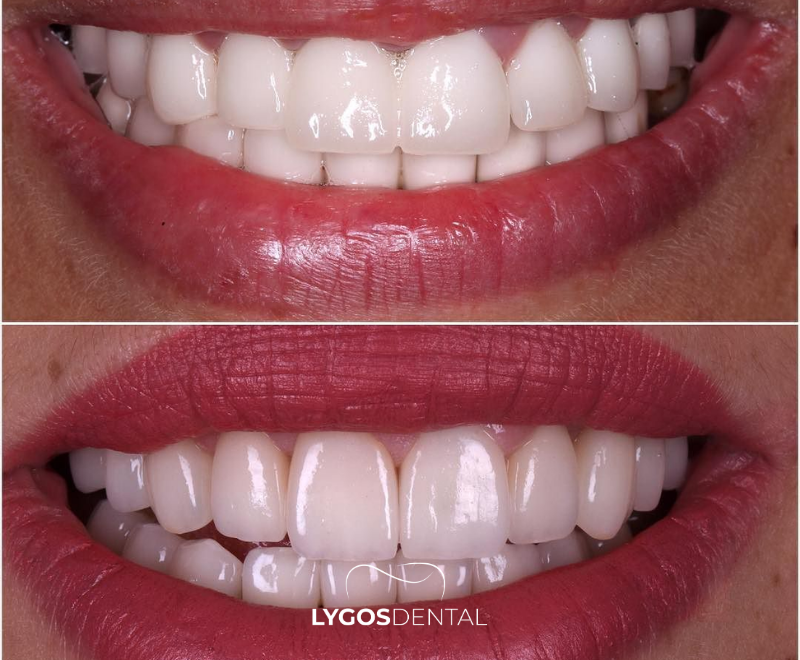 Emax or Zirconium on Implants