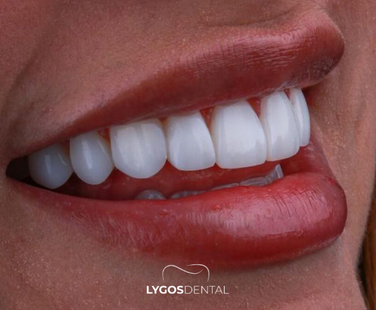 Emax or Zirconium on Implants