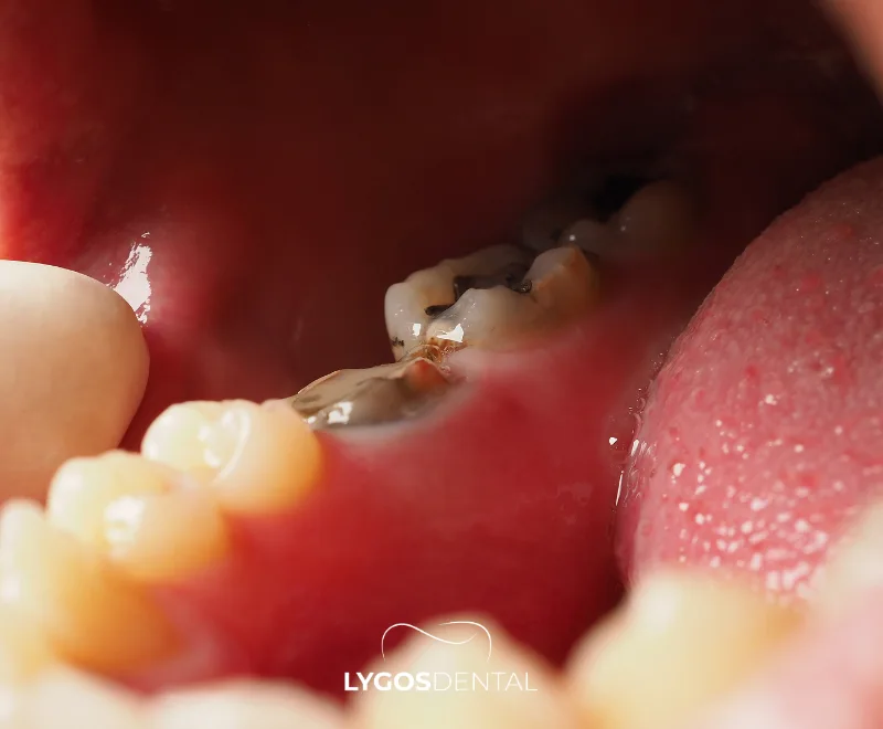 Symptoms of Tooth Decay