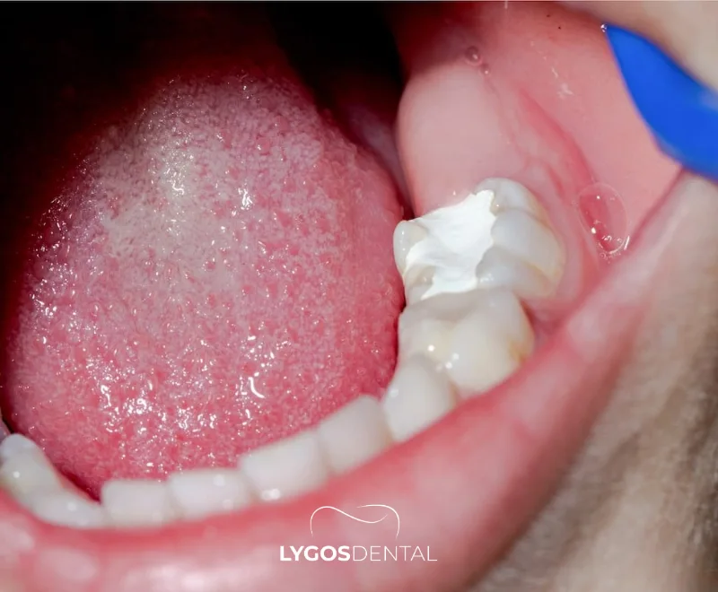 Symptoms of Tooth Decay