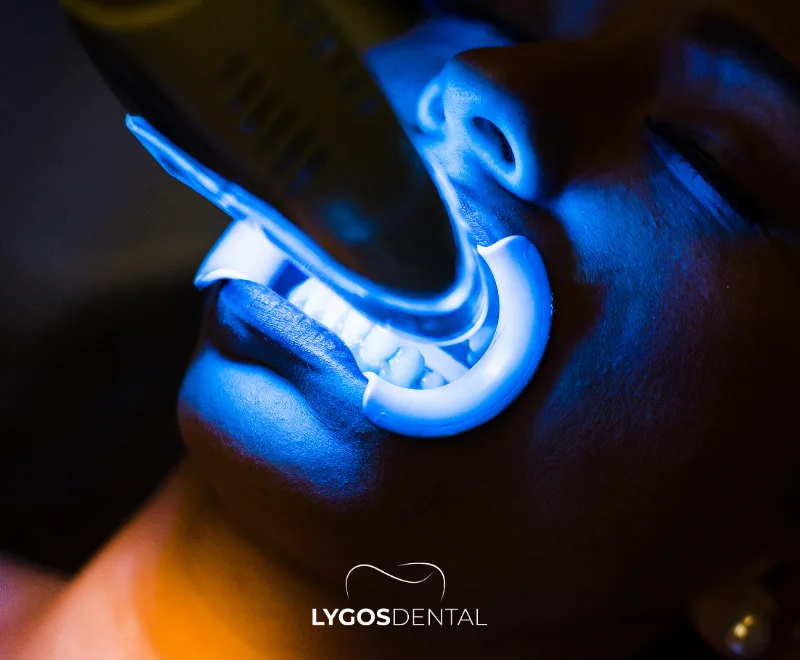 Ofis İçi Lazer Diş Beyazlatma Süreci ve Fiyatları 1 Ofis İçi Lazer Diş Beyazlatma Süreci ve Fiyatları