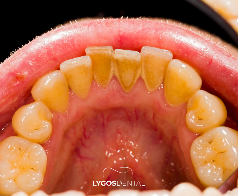 Por que o tártaro se forma?