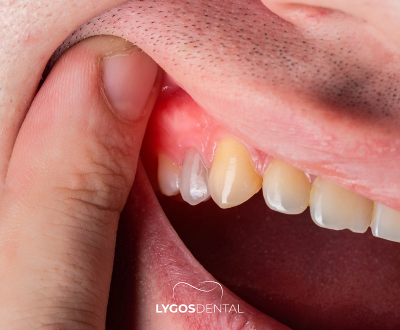 What is Gum Inflammation?