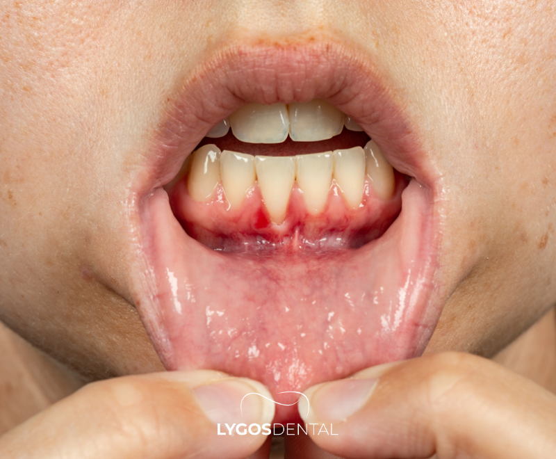 What is Chronic Periodontitis?